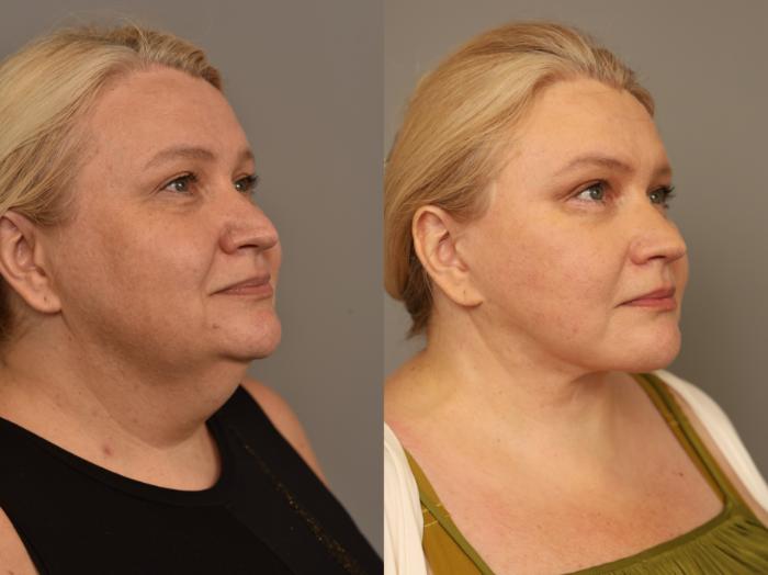 Before and after photos of a female patient with a lower face deep plane face lift