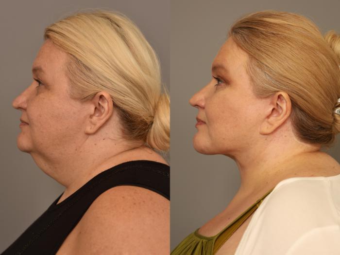 Before & After Facelift Case 278 Right Side View in New York, NY