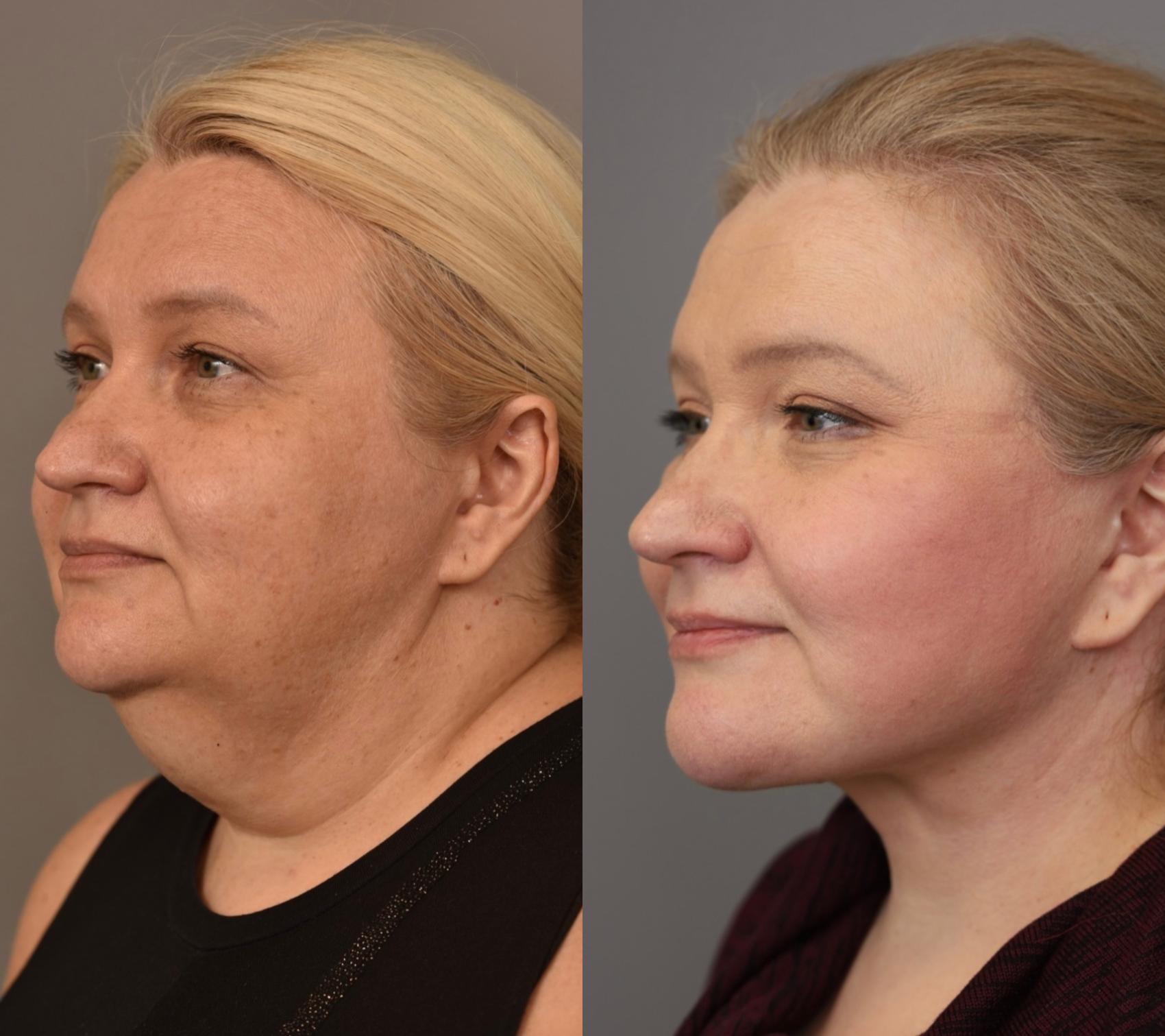 Before and after photos showing the right side of a woman's face following a facelift