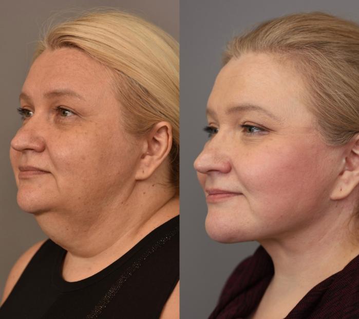 Before and after photos showing the right side of a woman's face following a facelift