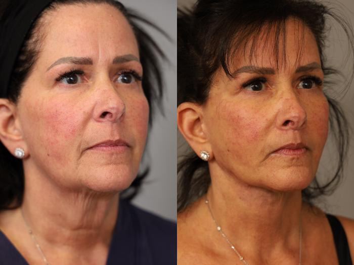 Before & After Facelift Case 292 Left Oblique View in New York, NY