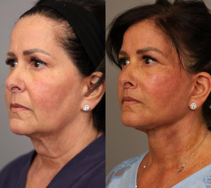 Before & After Facelift Case 292 Right Oblique View in New York, NY