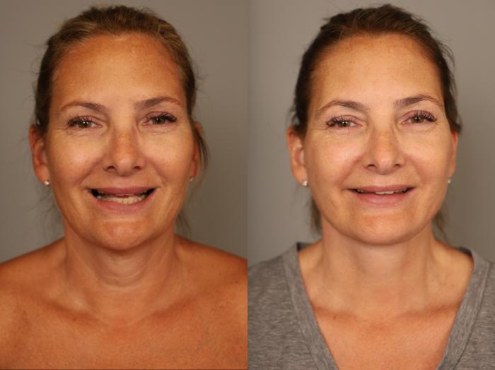 Before & After Facelift Case 306 Front View in New York, NY