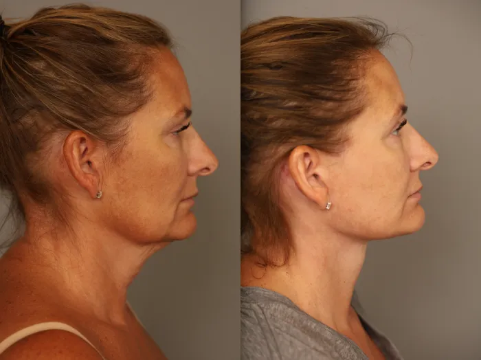 Facelift before and after results NYC patient