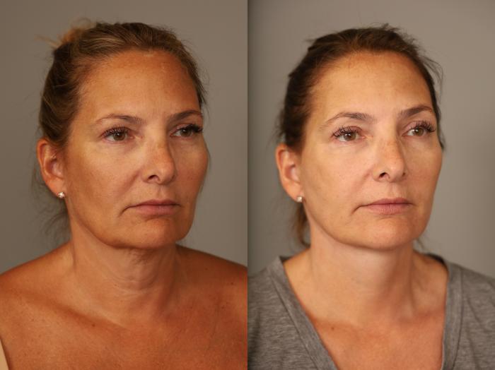 Extended Deep Plane Facelift Before and After photographs performed by Dr. Sterry in New York City