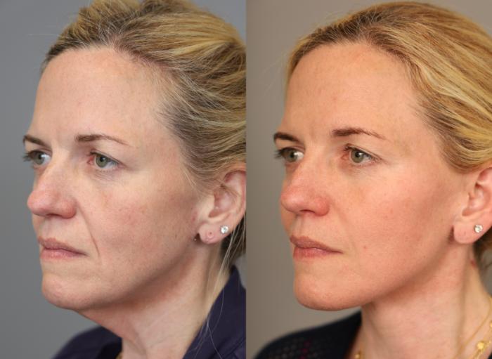 Before & After Facelift Case 307 Front View in New York, NY
