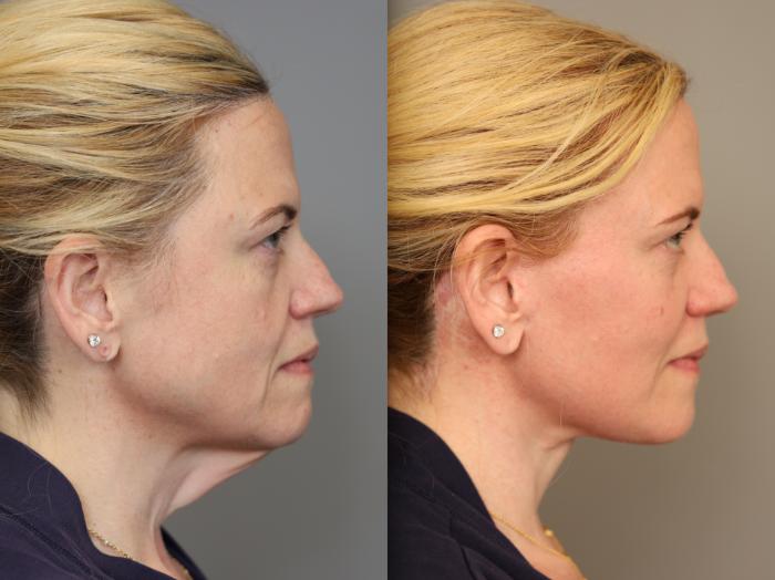 Before & After Facelift Case 307 Left Oblique View in New York, NY
