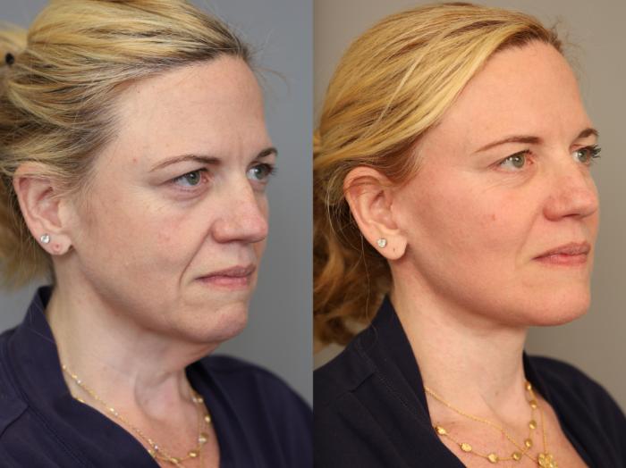 Before & After Facelift Case 307 Left Side View in New York, NY