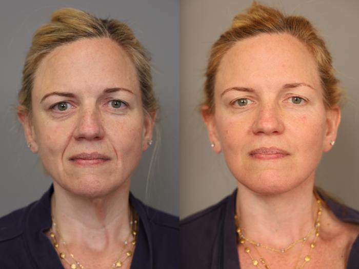 Before & After Facelift Case 307 Right Oblique View in New York, NY