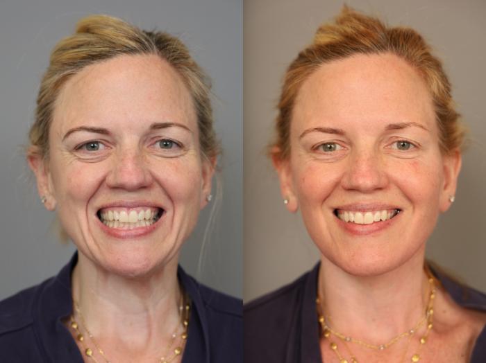 Before & After Facelift Case 307 Right Side View in New York, NY