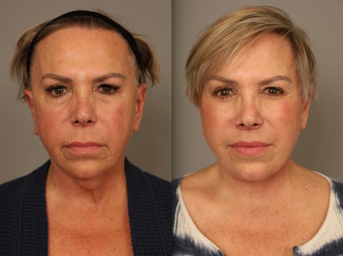 Before & After Facelift Case 310 Front View in New York, NY