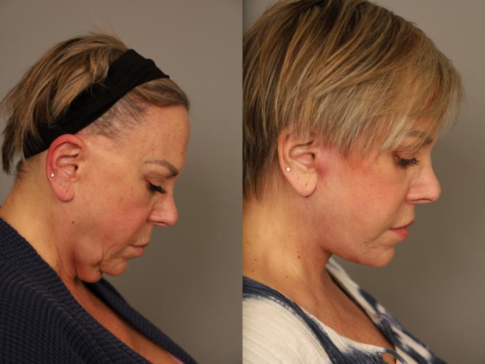 Before & After Facelift Case 310 Left Oblique View in New York, NY