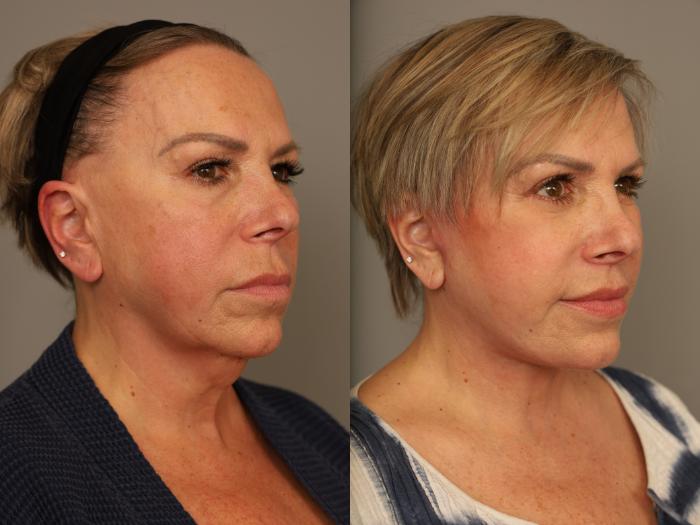 Before & After Facelift Case 310 Left Side View in New York, NY