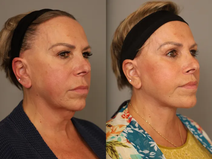 Facelift before and after results NYC patient