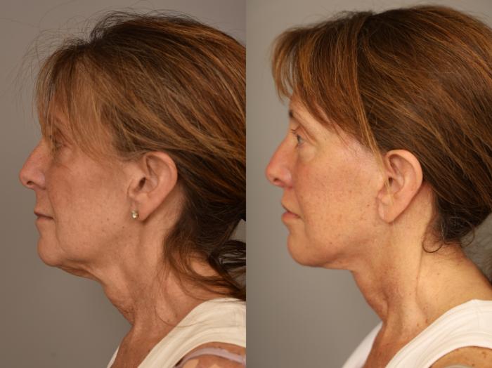Before & After Facelift Case 311 Right Side View in New York, NY