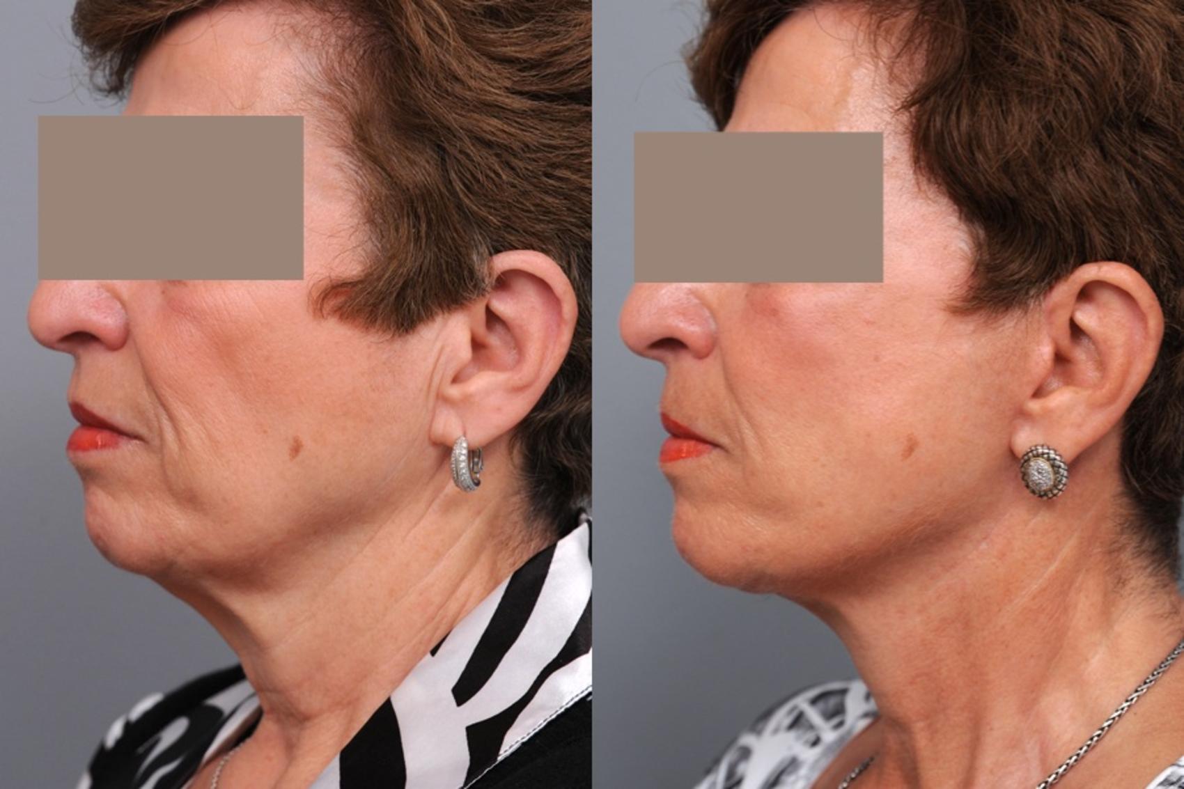 Before & After Facelift Case 75 View #2 View in New York, NY