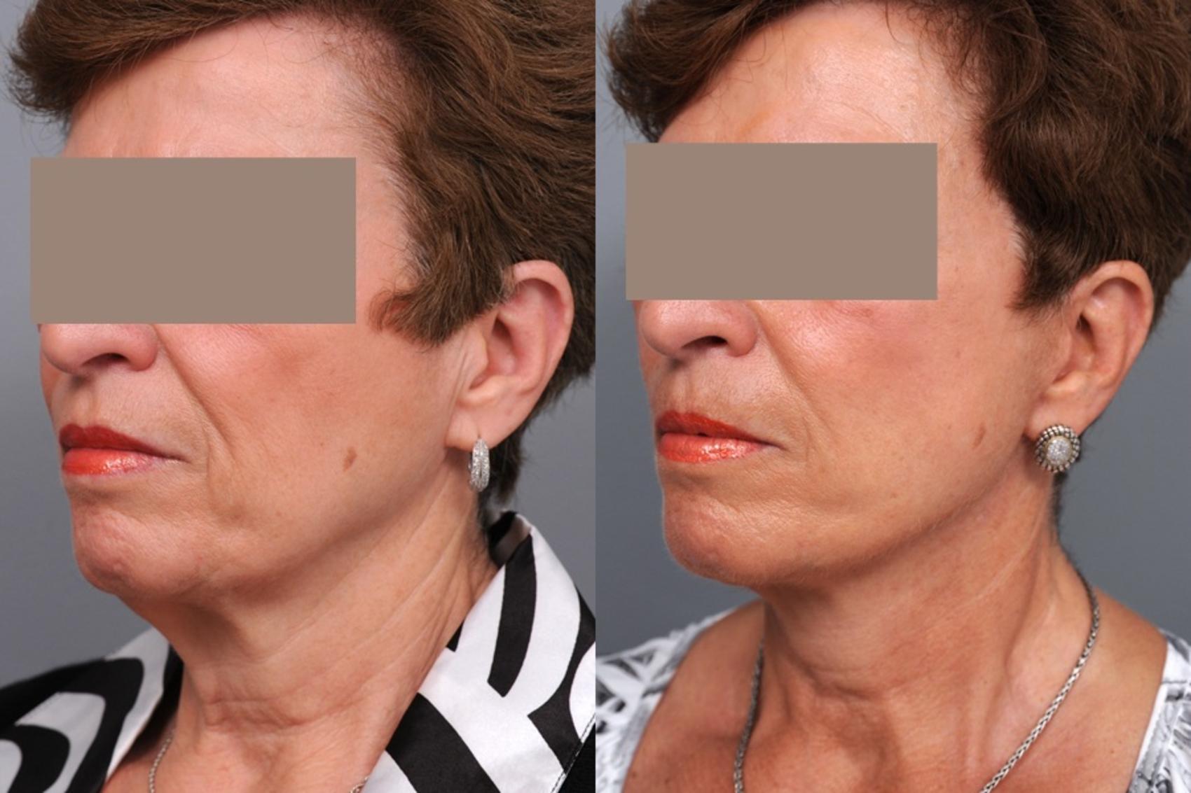 Before & After Facelift Case 75 View #3 View in New York, NY