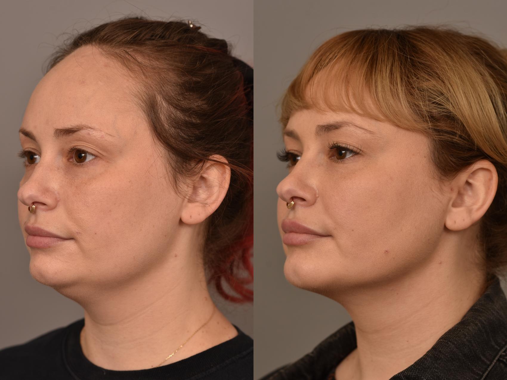 Before & After Facial Contouring Case 267 Left Oblique View in New York, NY