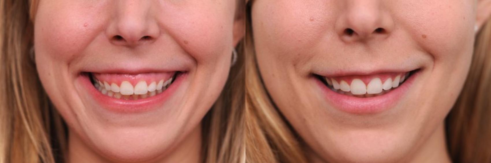 Gummy Smile Correction With Botox® Cosmetic In Nyc 4607