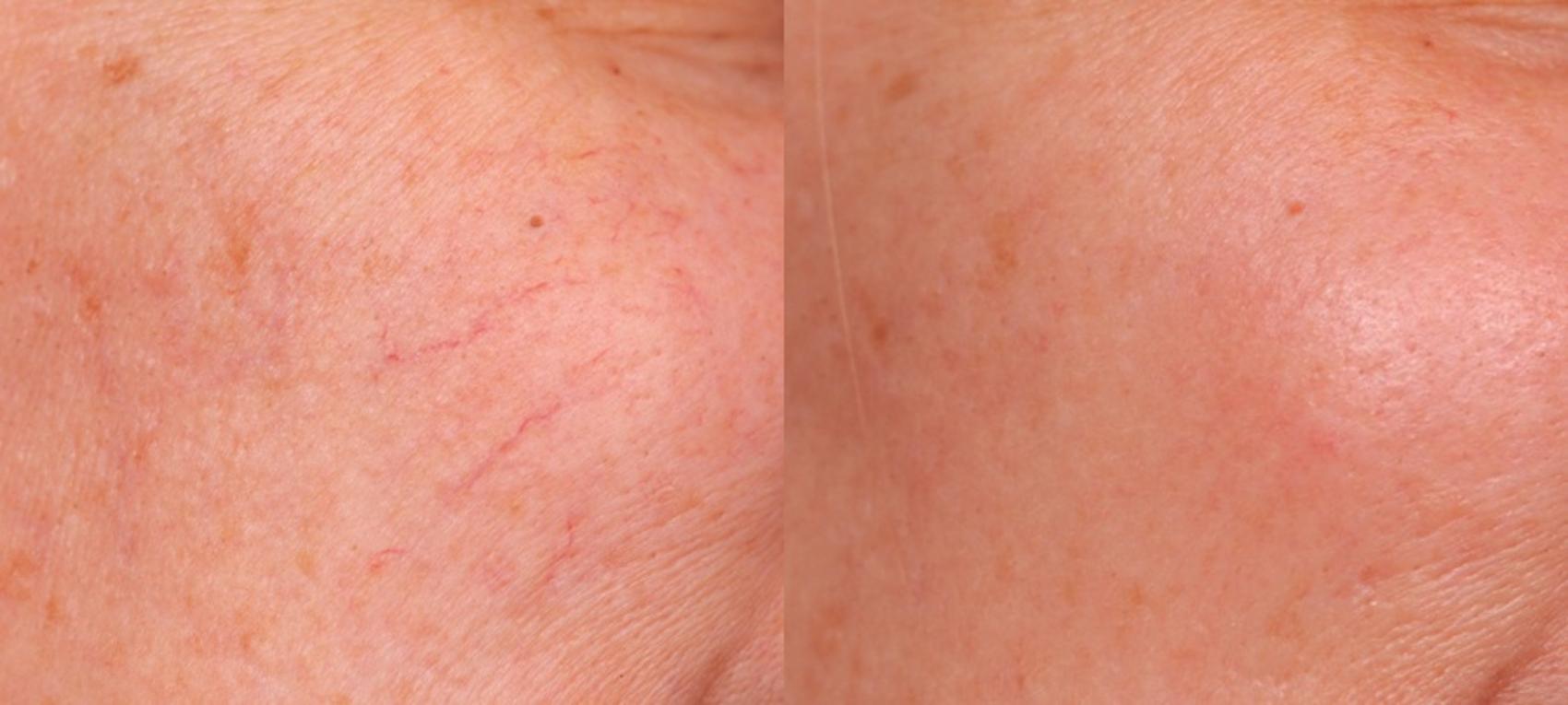 Before & After IPL Photofacial Case 84 View #1 View in New York, NY