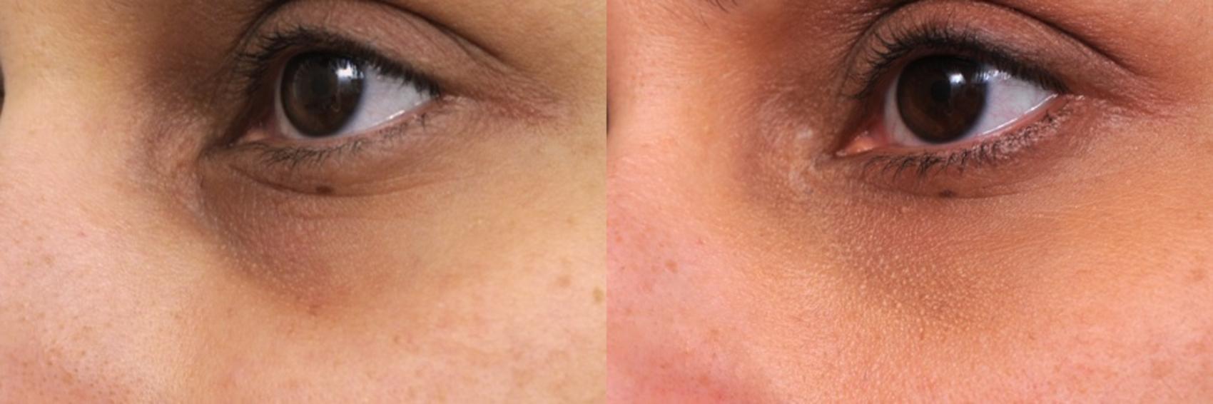 Before & After JUVEDERM® Case 28 View #1 View in New York, NY