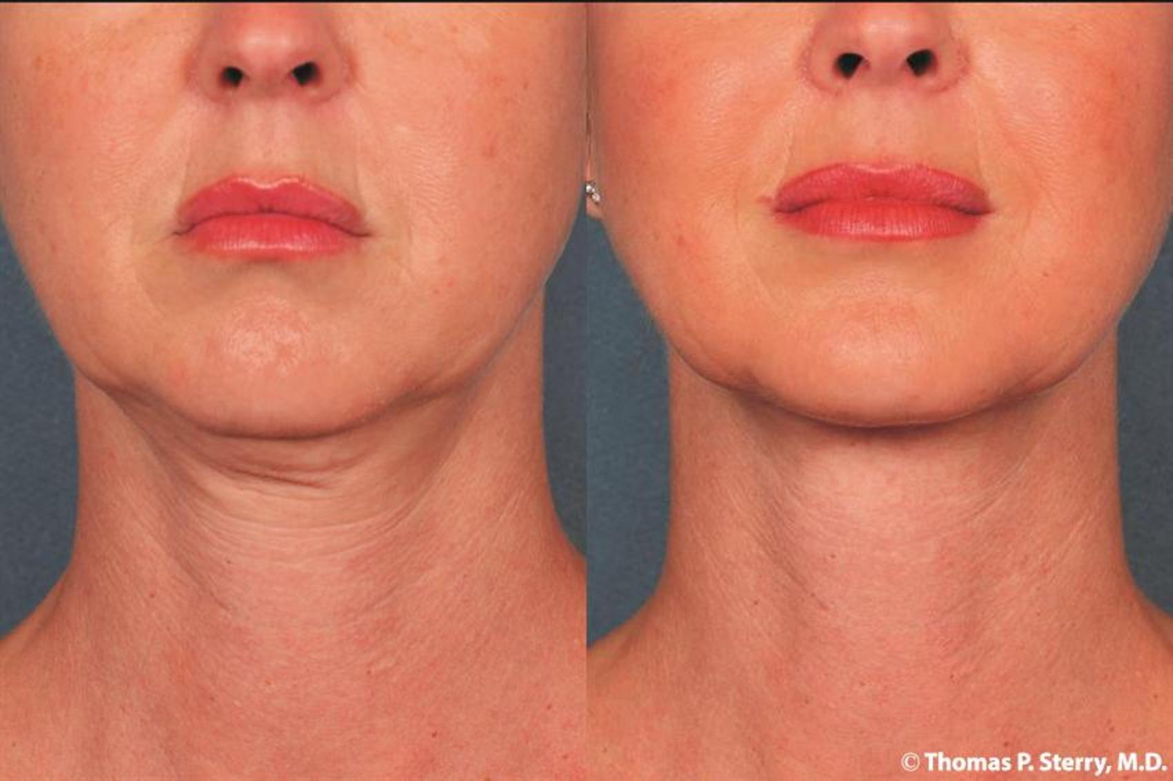 Before & After Kybella® Case 177 Front View in New York, NY