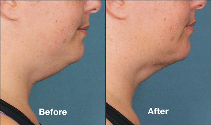 Before & After Kybella® Case 178 View #1 View in New York, NY