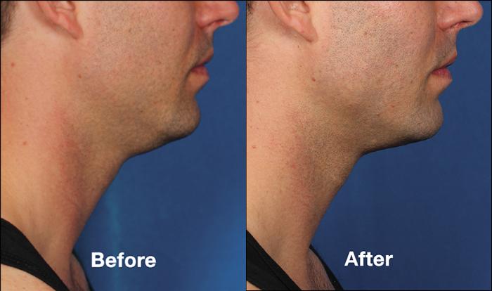 Before & After Kybella® Case 179 View #1 View in New York, NY