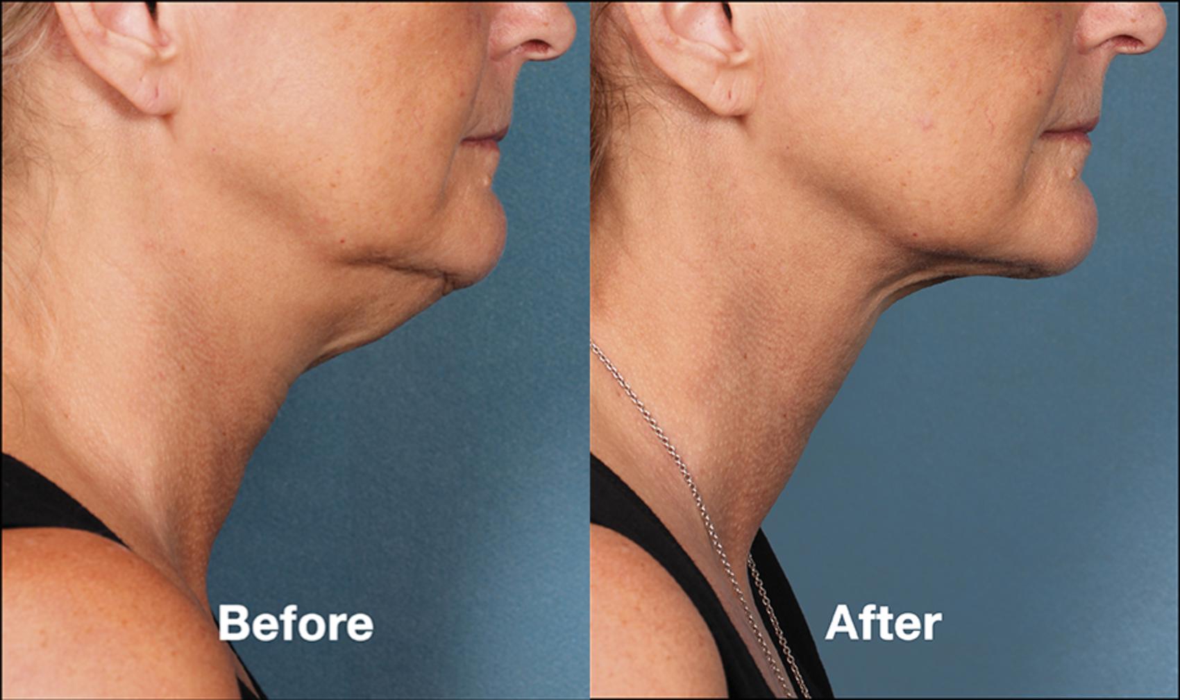 Before & After Kybella® Case 180 View #1 View in New York, NY