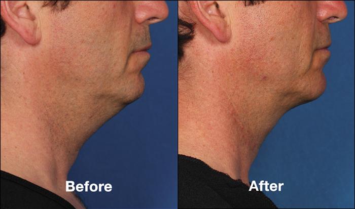 Before & After Kybella® Case 181 View #1 View in New York, NY