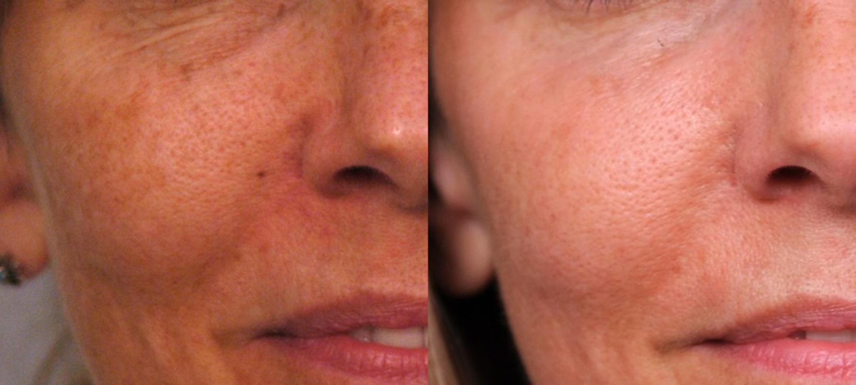 Before & After Laser Skin Rejuvenation Case 83 View #1 View in New York, NY