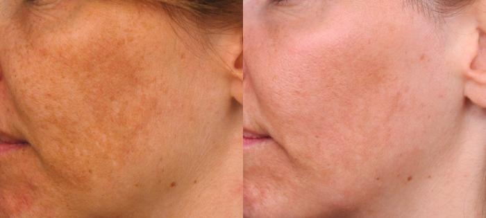 Before & After Laser Skin Rejuvenation Case 83 View #2 View in New York, NY