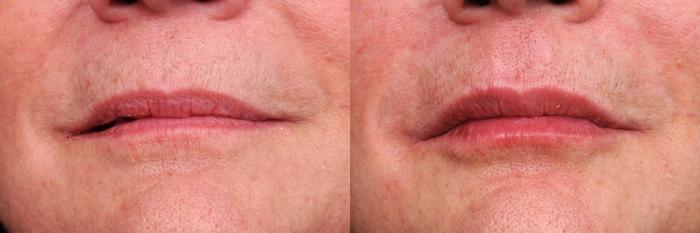Before & After Lip Injections Case 87 View #1 View in New York, NY