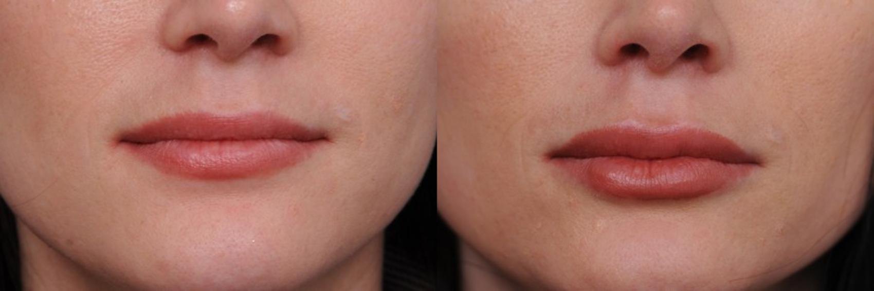 Before & After Lip Injections Case 88 View #1 View in New York, NY