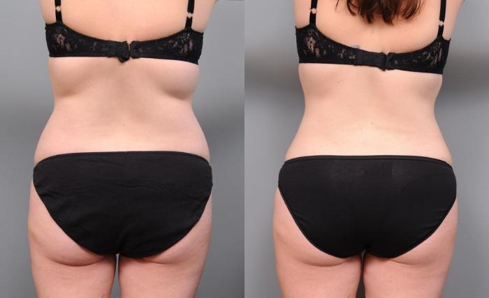 Before & After Liposuction Case 150 View #1 View in New York, NY