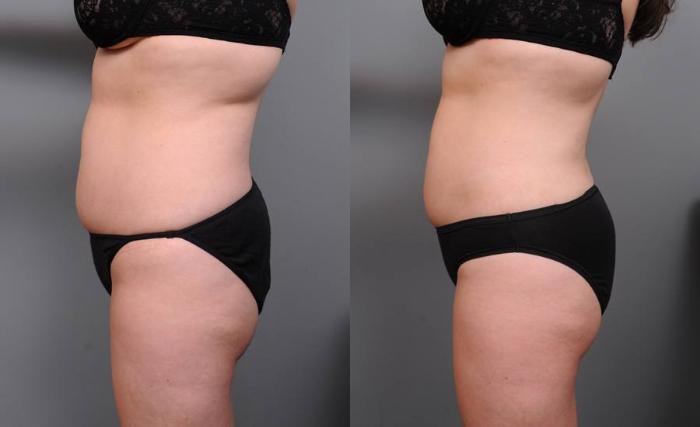 Before & After Liposuction Case 150 View #2 View in New York, NY