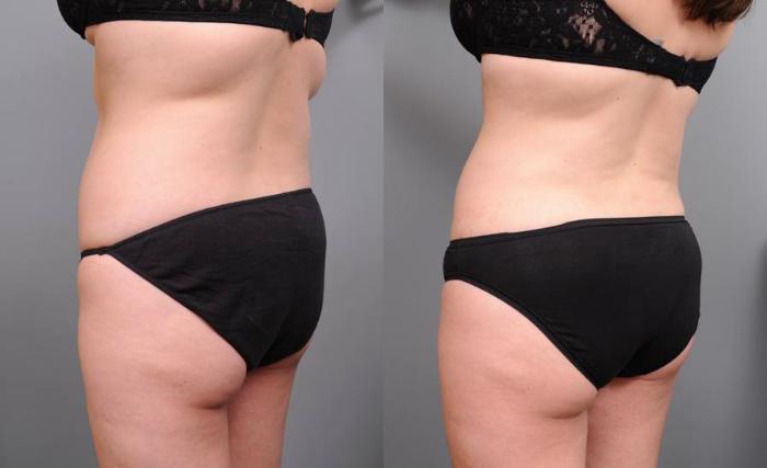Before & After Liposuction Case 150 View #3 View in New York, NY