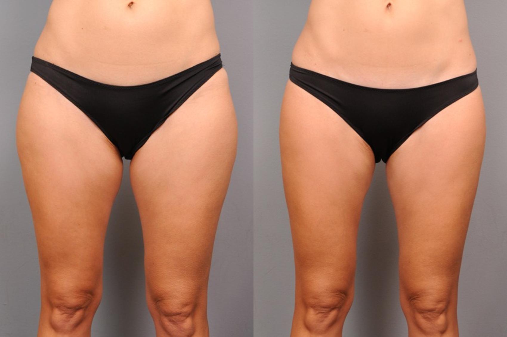 Before & After Liposuction Case 153 View #1 View in New York, NY