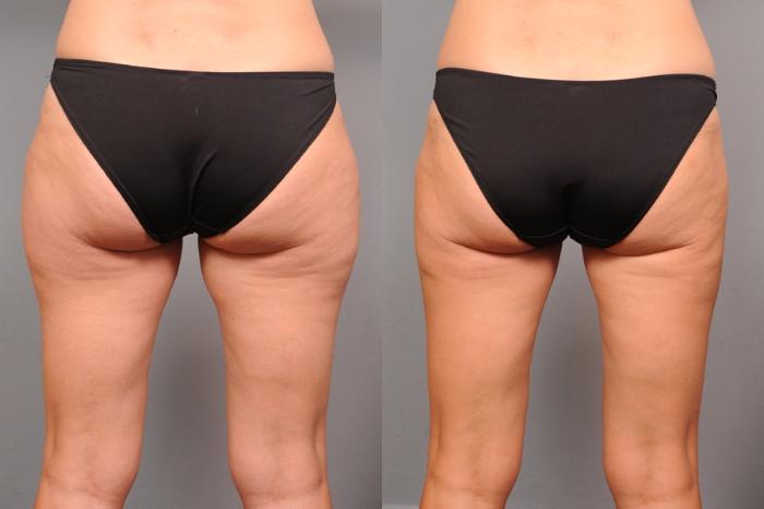 Before & After Liposuction Case 153 View #2 View in New York, NY