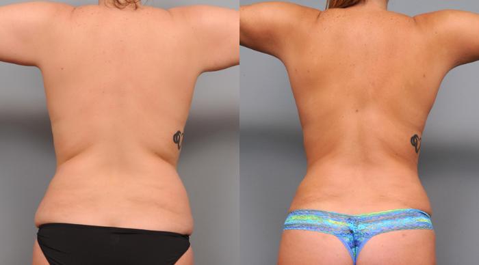 Before & After Liposuction Case 157 View #1 View in New York, NY