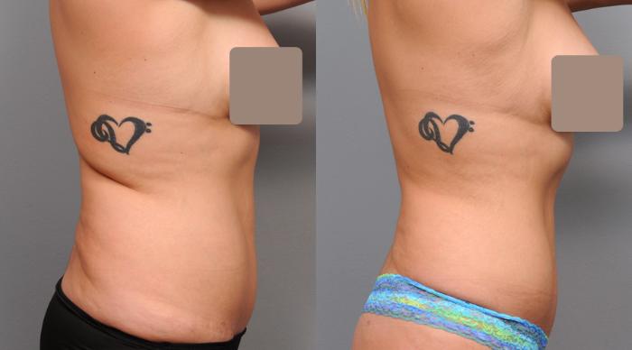 Before & After Liposuction Case 157 View #3 View in New York, NY