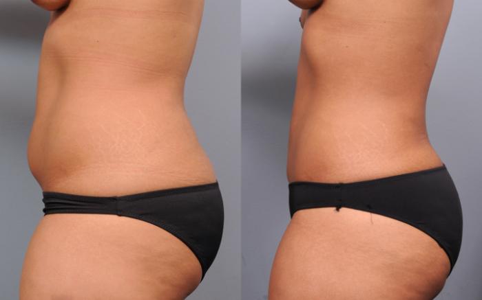 Before & After Liposuction Case 176 View #1 View in New York, NY