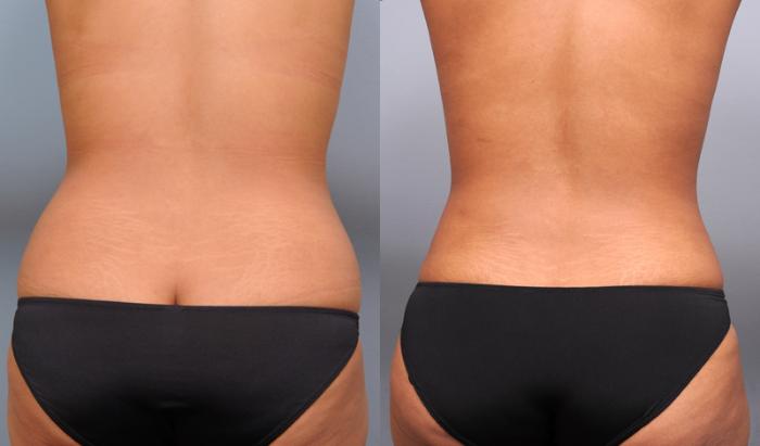 Before & After Liposuction Case 176 View #2 View in New York, NY