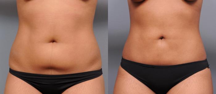 Before & After Liposuction Case 176 View #3 View in New York, NY