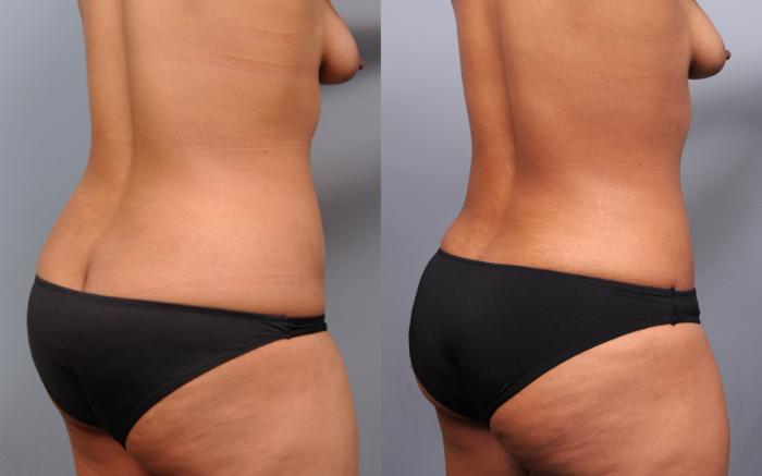 Before & After Liposuction Case 176 View #4 View in New York, NY