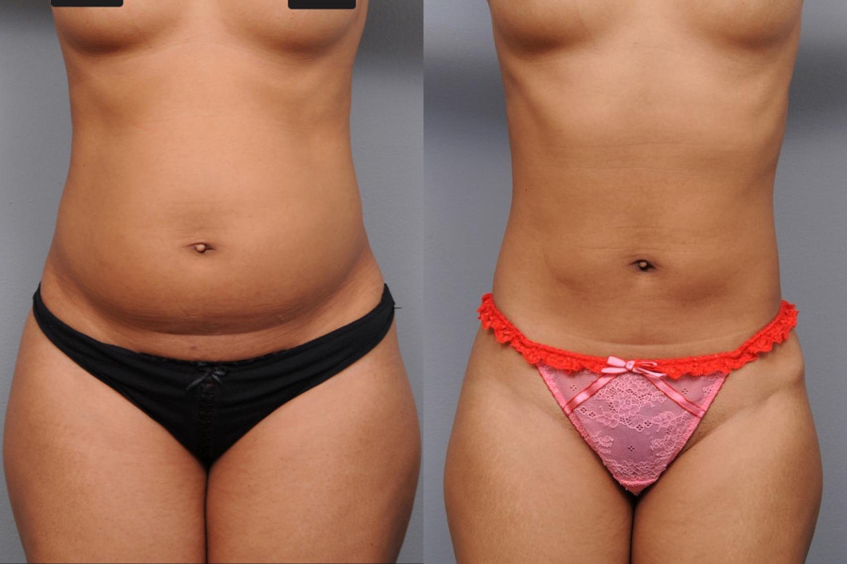 Before & After Liposuction Case 2 View #1 View in New York, NY