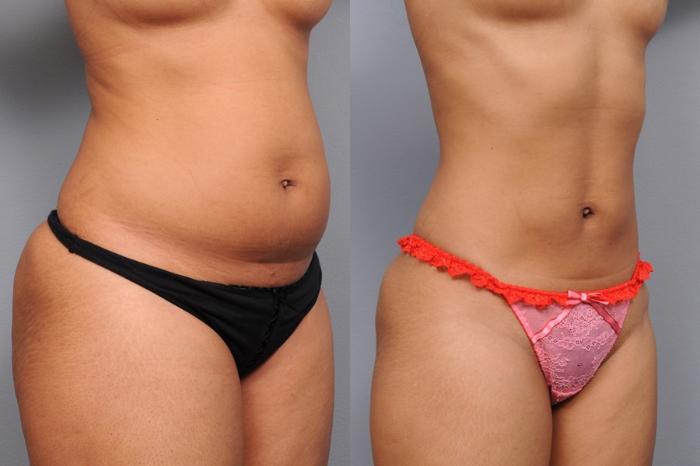 Before & After Liposuction Case 2 View #2 View in New York, NY