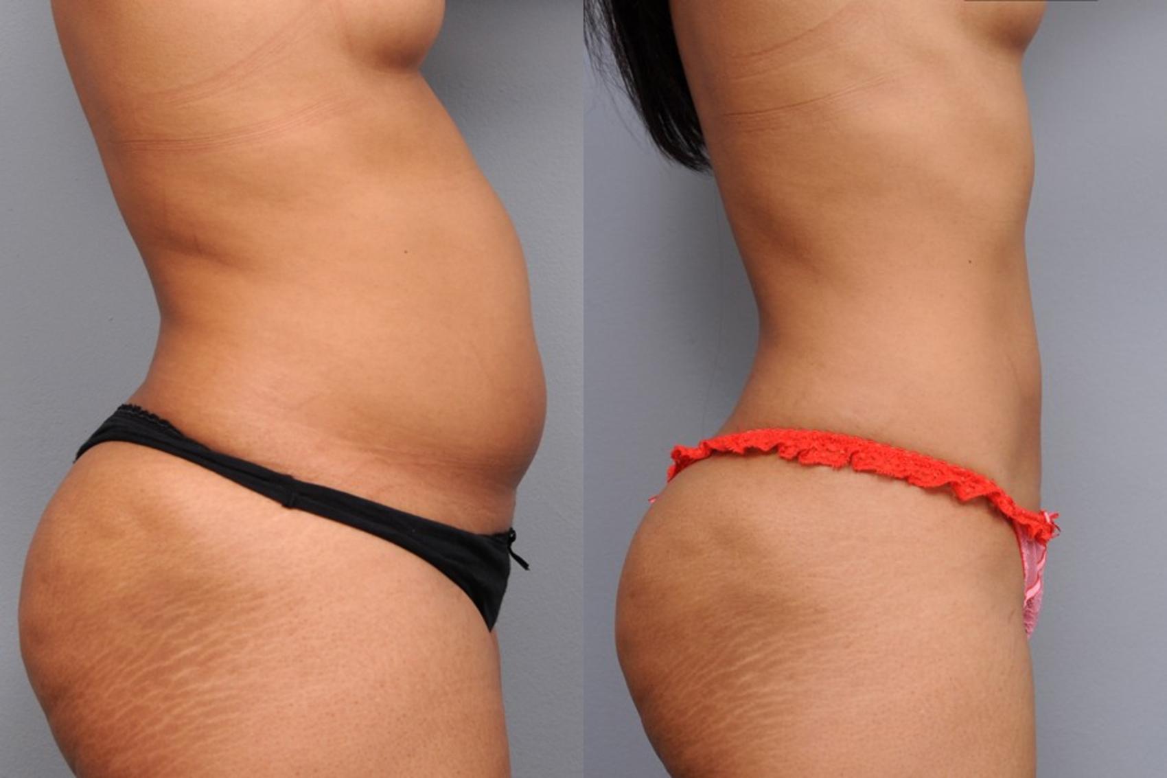 Before & After Liposuction Case 2 View #3 View in New York, NY