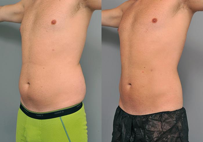Before & After Liposuction for Men Case 214 View #1 View in New York, NY