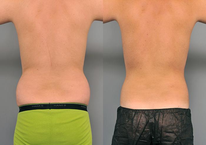 Before & After Liposuction for Men Case 214 View #2 View in New York, NY